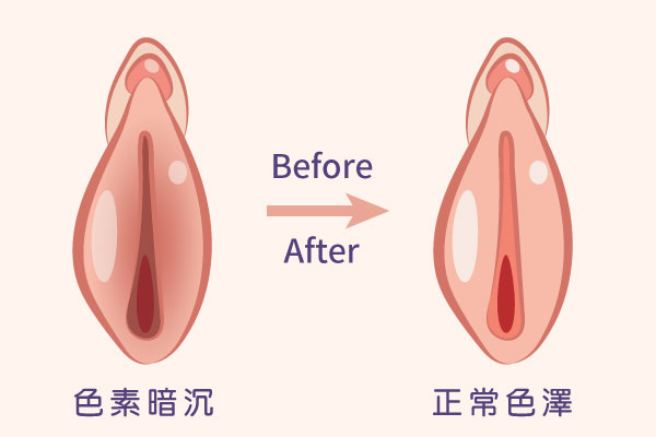 雷射美白,外陰雷射,雷射私密美型