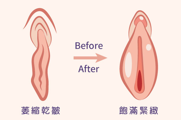 外陰萎縮,大陰唇粉嫩,雷射私密美型